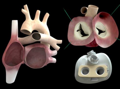 artificial-heart