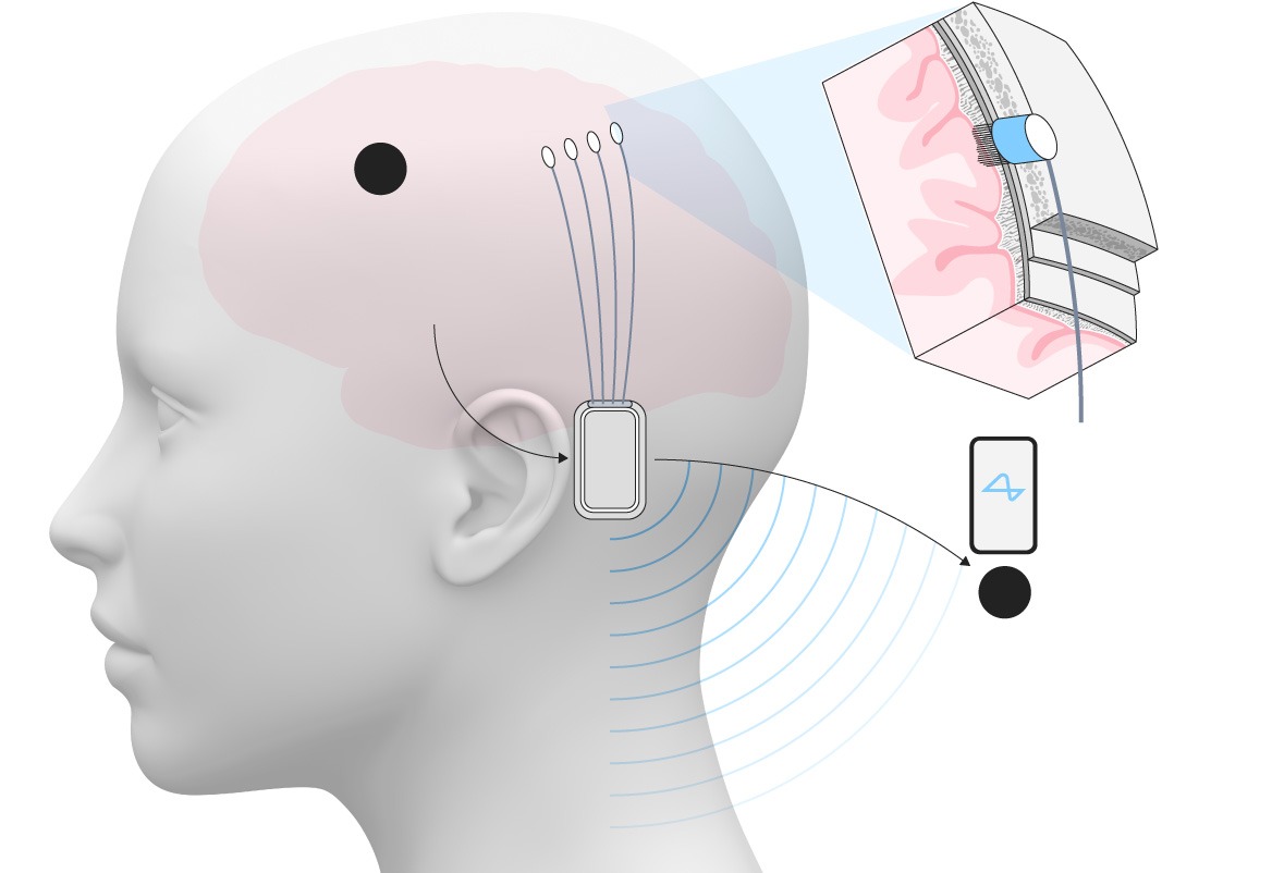 Neuralink Mulai Uji Coba Chip Otak di Inggris 3 Neuralink Inggris